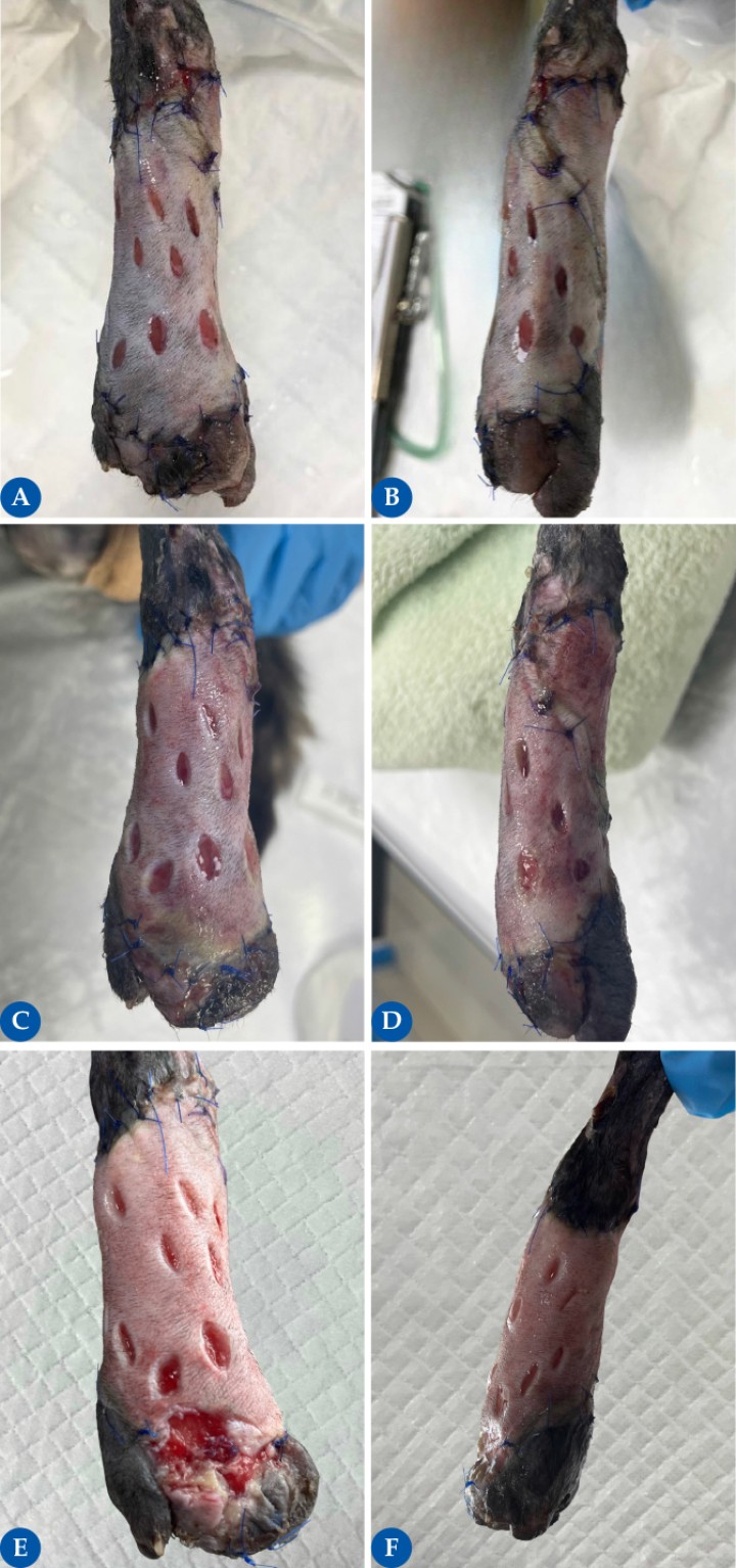 <p>Con la progresión de la vascularización puede seguir observándose los cambios de color característicos del injerto. Cuando se colocan inicialmente, los injertos son pálidos. Durante las 48 horas siguientes, a medida que comienza la inosculación (fase de anastomosis entre los vasos del lecho receptor y el injerto), el injerto puede tener un color entre rojo y morado oscuro debido a la congestión, ya que el flujo de entrada tiende a superar al de salida. Esto da paso a un tono rojizo más claro entre las 72 y 96 horas. En el séptimo u octavo día postoperatorio, todo el injerto es de color rojo a rosa si la supervivencia es completa. Hacia el día 14 se recupera gradualmente un color rosa pálido más normal. Las zonas de necrosis avascular se indican por una coloración pálida persistente (blanquecina o verde claro); estas zonas sufrirán necrosis y luego se desprenderán. La necrosis isquémica seca puede aparecer como una decoloración negra. Utilizando nuestro caso de ejemplo, obsérvese los cambios de color y aspecto durante los días 2 (7<strong>A</strong> dorsal, 7<strong>B</strong> lateral), 6 (7<strong>C</strong> dorsal, 7<strong>D</strong> lateral) y 9 (7<strong>E</strong> dorsal, 7<strong>F</strong> lateral) del periodo postoperatorio. En el día 6 (7<strong>C</strong>), se observó una pequeña zona verdosa en el aspecto más distal que acabó siendo debridada (7<strong>E</strong>), ya que adquirió un color grisáceo, con descarga mucopurulenta y sin adhesión al lecho receptor. Esta herida se dejó cicatrizar por segunda intención y se trató localmente con alginato cálcico y miel de manuka durante varios días.</p>