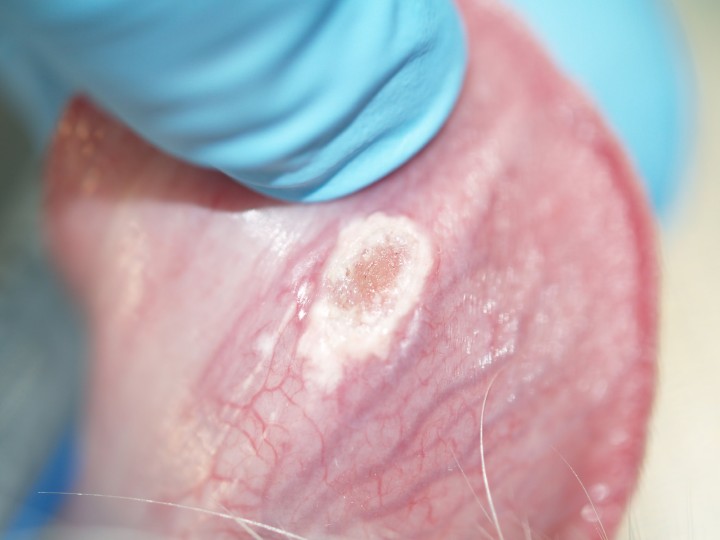 <p>Úlcera en el aspecto ventral de la lengua con bordes desvitalizados.</p>
