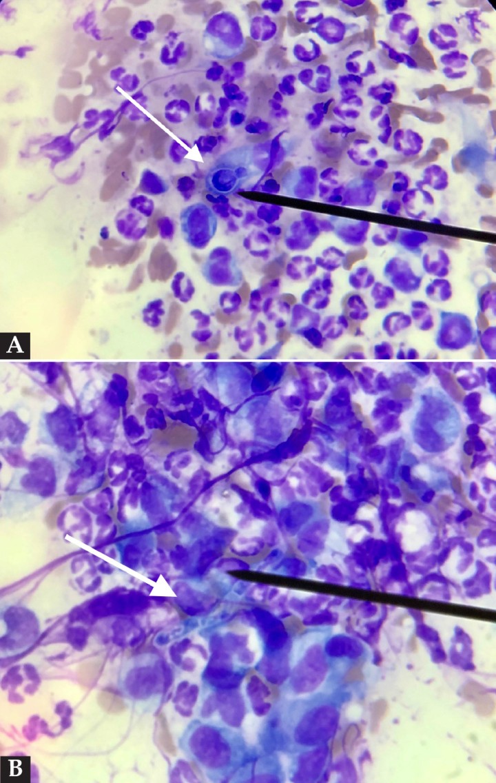 <p>(<strong>A</strong>) Citología procedente de las lesiones costrosas faciales donde se observa una estructura esférica y rodeada por una cápsula compatible con un microorganismo fúngico (flecha blanca) rodeada por neutrófilos degenerados y macrófagos. Tinción modificada Wright/Giemsa, x1000. (<strong>B</strong>) Imagen de la misma preparación donde se observa una hifa fúngica (flecha blanca) e inflamación neutrofílica y macrofágica. Tinción modificada Wright/Giemsa, x1000.</p>