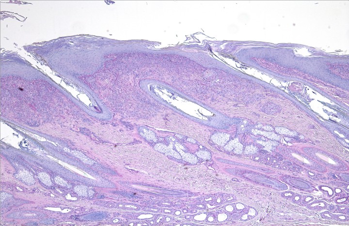 <p>Corte histológico de la piel nasal. Se aprecia hiperplasia epidérmica y un infiltrado inflamatorio difuso en la dermis superficial. PAS x100.</p>