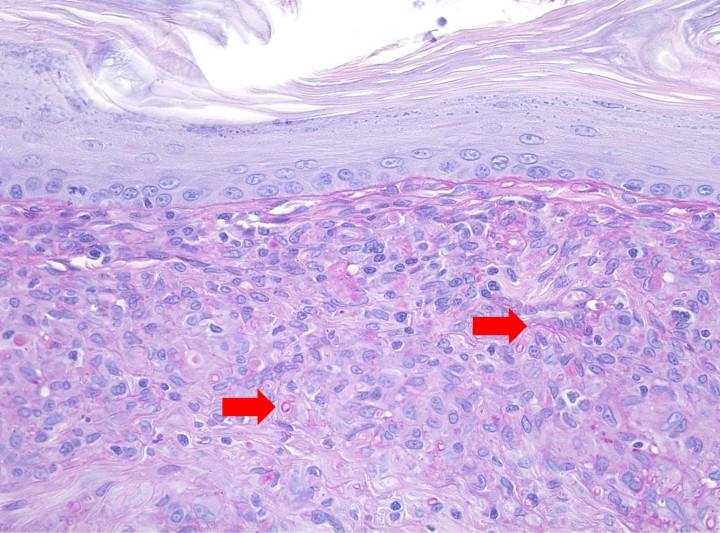 <p>Imagen de la misma muestra de la Figura 6. El infiltrado inflamatorio es predominantemente granulomatoso y entre las células macrofágicas se observan estructuras micóticas, con la pared de un color eosinofílico más intenso. PAS x400.</p>