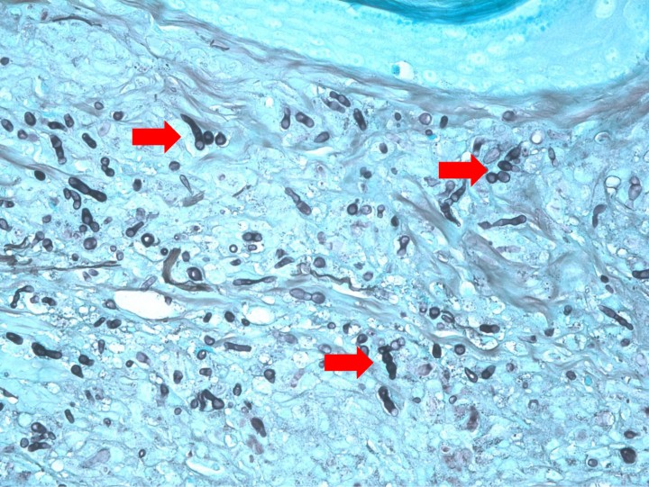 <div>
<div class=\"Basic-Text-Frame\">
<p>Imagen de la misma preparación de la Figura 6 en la que se aprecian hifas irregulares segmentadas, teñidas con la tinción argéntica de color negro. Grocott x600.</p>
</div>
</div>
