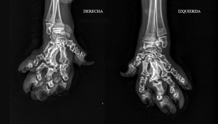 <p>Proyección dorsopalmar de la parte distal de las extremidades anteriores (<em>manus</em>) del paciente donde se observan lesiones similares (aunque más leves) a nivel de carpos, metacarpos y falanges que los encontrados a nivel de tarsos, metatarsos y falanges en las extremidades posteriores.</p>