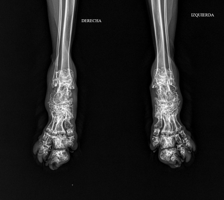 <p>Proyección dorsoplantar de la parte distal de las extremidades posteriores (<em>pes</em>) del paciente donde se observa acortamiento, deformidad y engrosamiento de tarsos, metatarsos y falanges, así como pérdida de los espacios articulares de dichas zonas.</p>