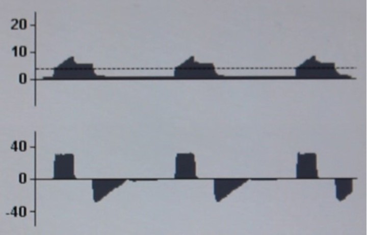 <p><strong>VCV normal</strong>. Observamos la curva de presión-tiempo (P-T) típica de VCV en la parte superior de la imagen y en la parte inferior, la curva de flujo-tiempo (F-T). La curva P-T muestra un incremento progresivo de la presión hasta llegar a un pico (presión pico), que corresponde con la presión necesaria para vencer resistencias en vía aérea. Posteriormente, se mantiene una presión continua (presión meseta o plateau), que corresponde a la pausa inspiratoria y refleja la presión que alcanza los alveolos durante la ventilación. Finalmente, la presión desciende hasta cero o hasta la presión positiva final espiratoria (<em>positive end-expiratory pressure</em>, PEEP) que hayamos pautado. La curva F-T muestra un flujo inspiratorio continuo, de forma cuadrada, típico de la VCV. El flujo espiratorio muestra un pico inicial y luego decrece en velocidad, y depende únicamente de la espiración pasiva realizada por el paciente. Entre ambos se observa una fase de flujo cero, correspondiente a la pausa inspiratoria.</p>