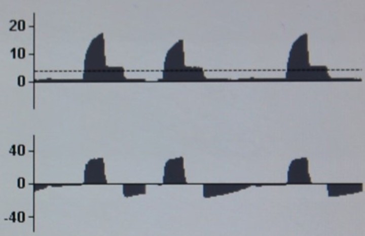 <p><strong>Aumento de resistencias en VCV</strong>. En la curva P-T se observa un aumento de la presión pico sin modificación de la presión meseta. En la curva F-T se modifica el flujo espiratorio, observándose un pico menor (menor velocidad de flujo), así como la prolongación del tiempo espiratorio. Esta situación podría deberse, entre otros, a un acodamiento del tubo endotraqueal, a su obstrucción por secreciones o a un broncoespasmo.</p>