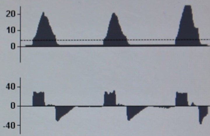 <p><strong>Disminución de la distensibilidad del sistema respiratorio en VCV</strong>. En la curva P-T se observa un aumento tanto de la presión pico como de la presión meseta. La curva F-T no se modifica. Esta situación podría deberse a cualquier evento que cause una reducción de la distensibilidad pulmonar o torácica como, por ejemplo, el inicio del neumoperitoneo en cirugía laparoscópica.</p>