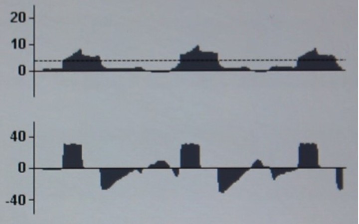 <p><strong>Desacoplamiento (“lucha”) paciente – ventilador en VCV</strong>. En la curva P-T se observan fases de presión negativa intercaladas con las ventilaciones por presión positiva habituales, y en la curva de flujo-tiempo se observan pequeños picos de flujo inspiratorio y espiratorio intercalados con las ventilaciones dadas por el ventilador. En ambos casos los cambios se corresponden con esfuerzos inspiratorios espontáneos del paciente. En PCV se observarían cambios similares. Esta situación puede deberse a un plano anestésico insuficiente, a hipercapnia o al fin del bloqueo neuromuscular en caso de estar empleándose.</p>