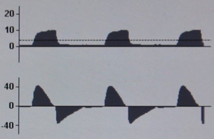<p><strong>PCV normal. </strong>Observamos las curvas P-T y F-T típicas de PCV. La curva P-T muestra un incremento más rápido que en VCV, llegando a la presión inspiratoria pautada en el ventilador, y se mantiene hasta la fase espiratoria. No se observan ni presión pico ni presión meseta. Después, la presión desciende hasta cero o hasta la PEEP seleccionada. La curva F-T muestra un flujo inspiratorio decelerado, típico de la PCV. Inicialmente el flujo inspiratorio es rápido, hasta alcanzar la presión pautada, y desciende posteriormente para mantenerla durante toda la fase inspiratoria. El flujo espiratorio es idéntico al observado en VCV y depende solo del paciente. No debe observarse fase de flujo cero, ya que en PCV no se utiliza pausa inspiratoria.</p>