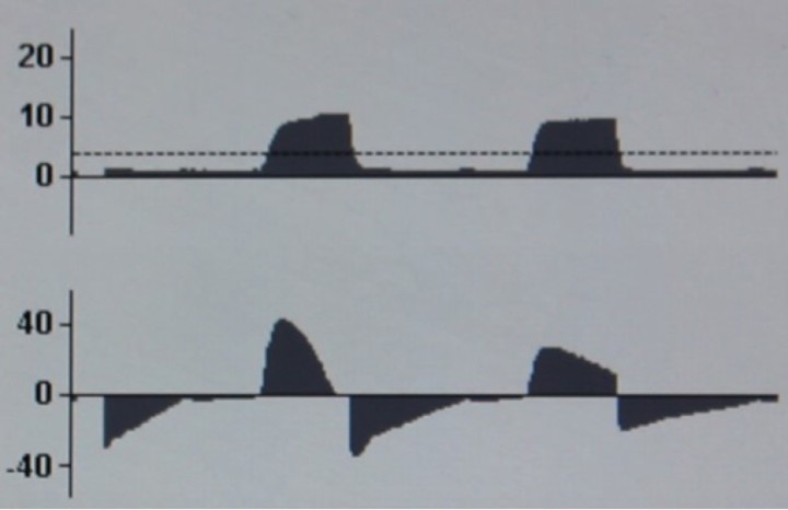 <p><strong>Aumento de resistencias en PCV</strong>. En la curva P-T no se observa ningún cambio. En la curva F-T se modifica el flujo espiratorio del mismo modo que ocurría en VCV.</p>