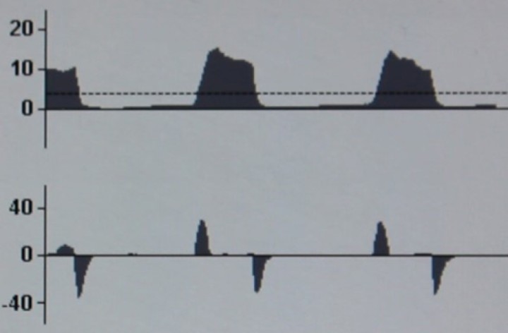 <p><strong>Disminución de la distensibilidad del sistema respiratorio en PCV</strong>. En la curva P-T no se observan cambios. En la curva F-T se reduce el flujo tanto inspiratorio como espiratorio, ya que se suministra menos volumen corriente al paciente para alcanzar la presión pautada.</p>