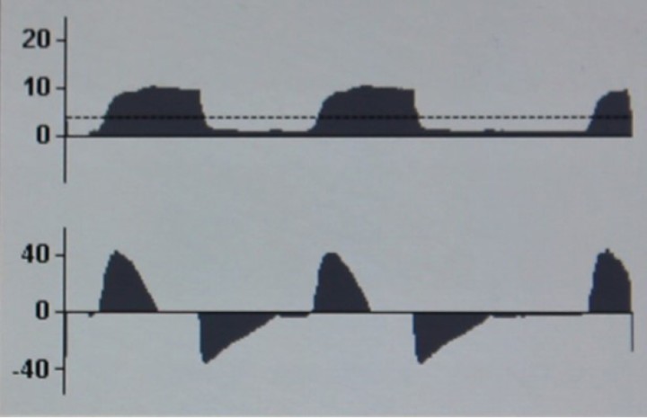<p><strong>Tiempo inspiratorio excesivo en PCV</strong>. En la curva F-T se observa una fase de flujo cero, lo que indica que se está manteniendo la presión inspiratoria sin ninguna administración de flujo ni, por tanto, de volumen corriente. Esto indica que el tiempo inspiratorio es excesivo y podemos reducirlo para disminuir los efectos negativos de la presión positiva mantenida en vía aérea.</p>