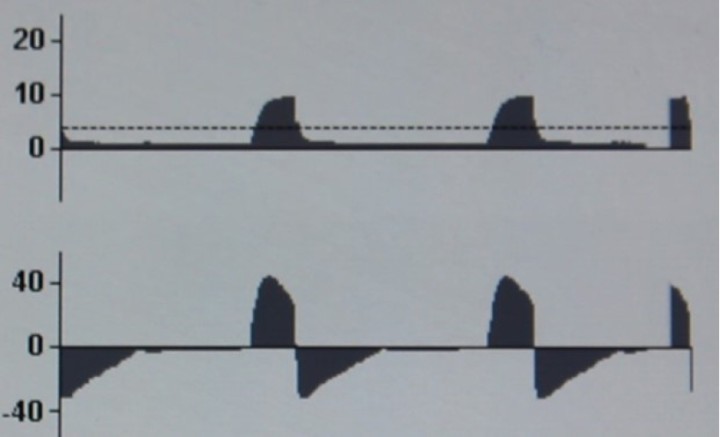<p><strong>Tiempo inspiratorio insuficiente en PCV</strong>. En la curva F-T se observa que el flujo inspiratorio no llega a cero antes de cambiar a fase espiratoria. Esto indica que no se administra todo el volumen corriente posible para la presión inspiratoria seleccionada y que, por tanto, el tiempo inspiratorio es insuficiente. Aumentando el tiempo inspiratorio aumentaría el volumen corriente sin incrementarse la presión inspiratoria.</p>