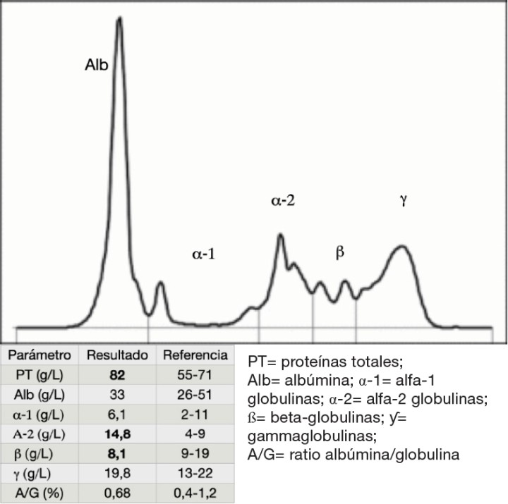 <p>Electroforesis de proteínas en suero.</p>