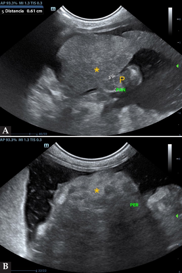 <p>(<strong>A</strong>) Masa abdominal (*) asociada a la zona pancreática (P). (<strong>B</strong>) Masa abdominal de grandes dimensiones (*) y líquido libre abdominal.</p>