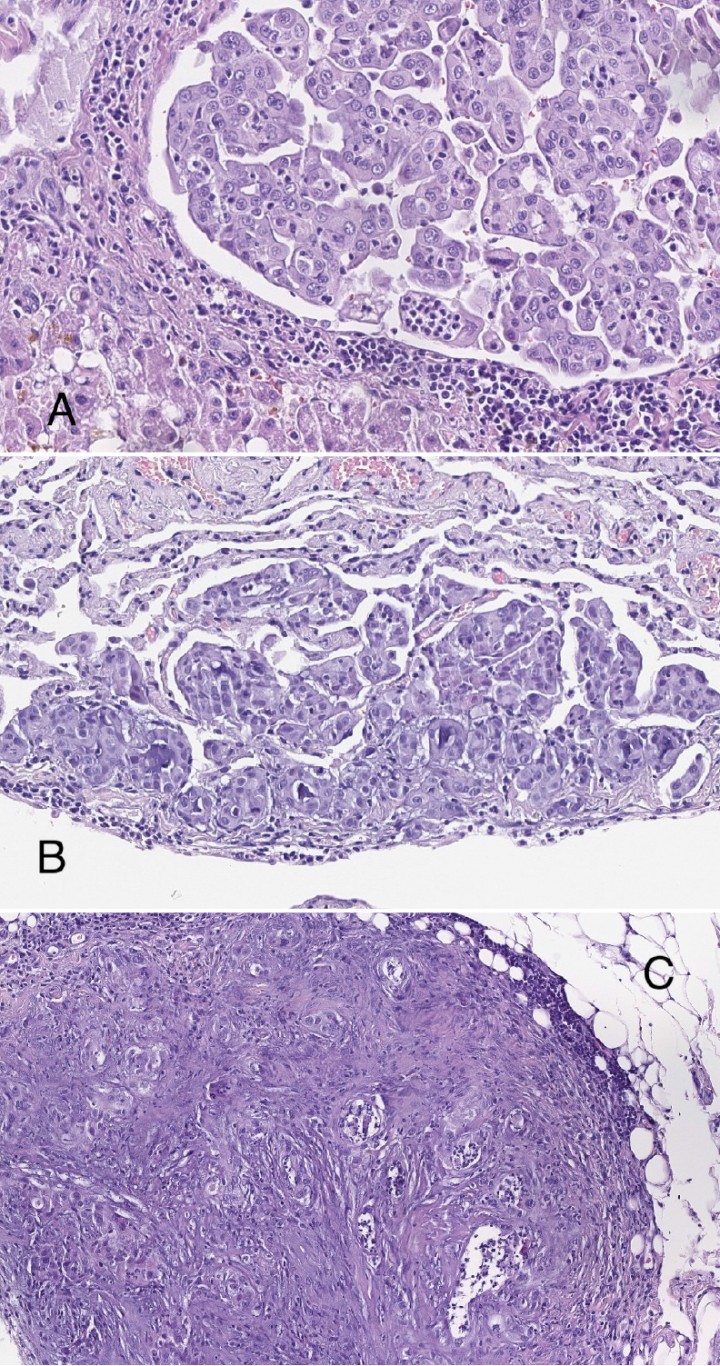 <div class=\"Basic-Text-Frame\">
<p>(<strong>A</strong>) Imagen de la infiltración de la neoplasia en hígado (x200, tinción H/E). (<strong>B</strong>) Imagen de la infiltración de la neoplasia en pulmón (x200, tinción H/E). (<strong>C</strong>) Infiltración de la neoplasia en serosa (x200, tinción H/E).</p>
</div>