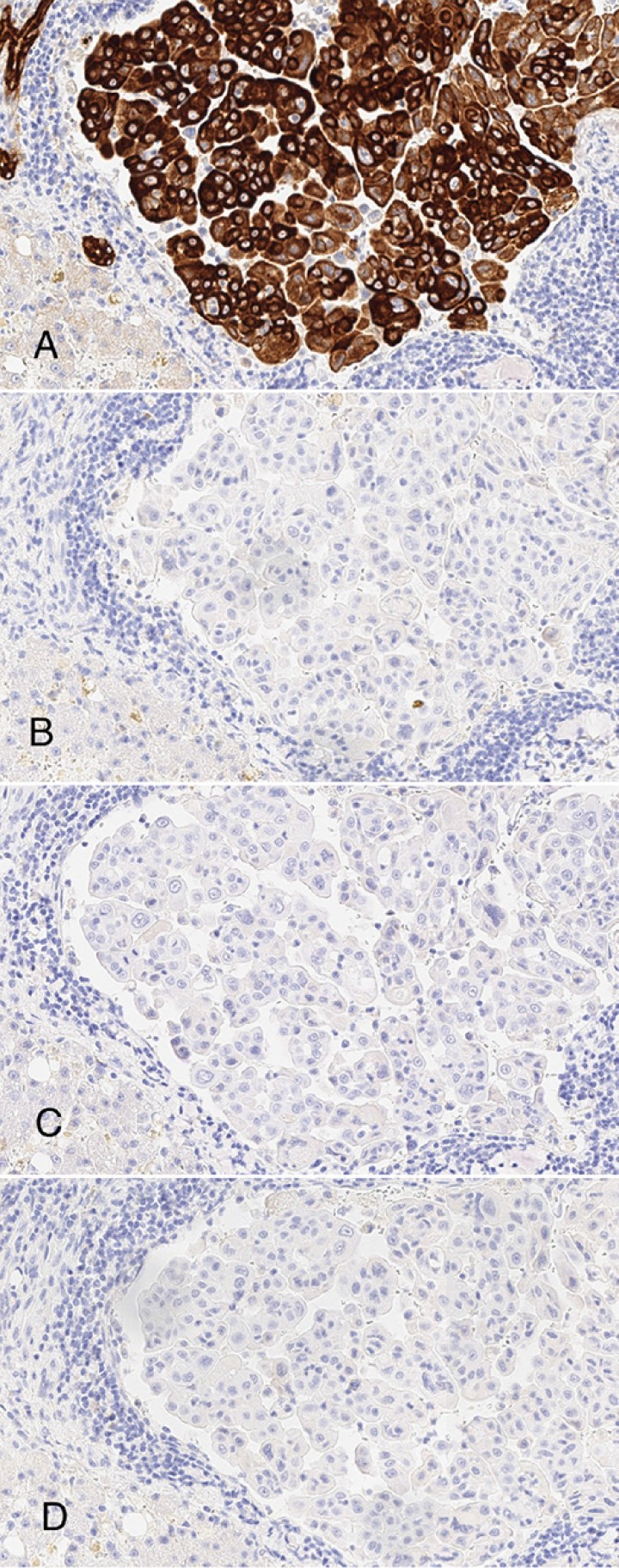 <p>(<strong>A</strong>) Células neoplásicas positivas para AE1 AE 2 (x200, tinción inmunohistoquímica para citoqueratinas AE1 AE2). (<strong>B</strong>) Células neoplásicas negativas para CEA (x200, tinción inmunohistoquímica para CEA). (<strong>C</strong>) Células neoplásicas negativas para Cromogranina (x200, tinción inmunohistoquímica para Cromogranina). (<strong>D</strong>) Células neoplásicas negativas para Sinaptofisina (x200, tinción inmunohistoquímica para Sinaptofisina).</p>