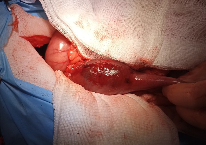 Imagen intraquirúrgica de la lesión duodenal. Nótese el aumento de grosor del tracto digestivo duodenal y el cambio de coloración.