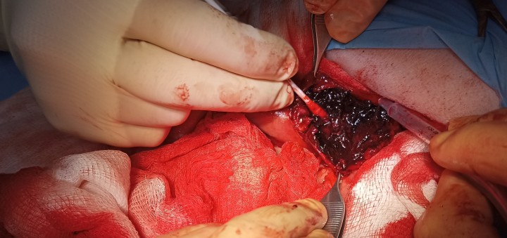 Imagen intraquirúrgica de la lesión duodenal tras su apertura y examen.