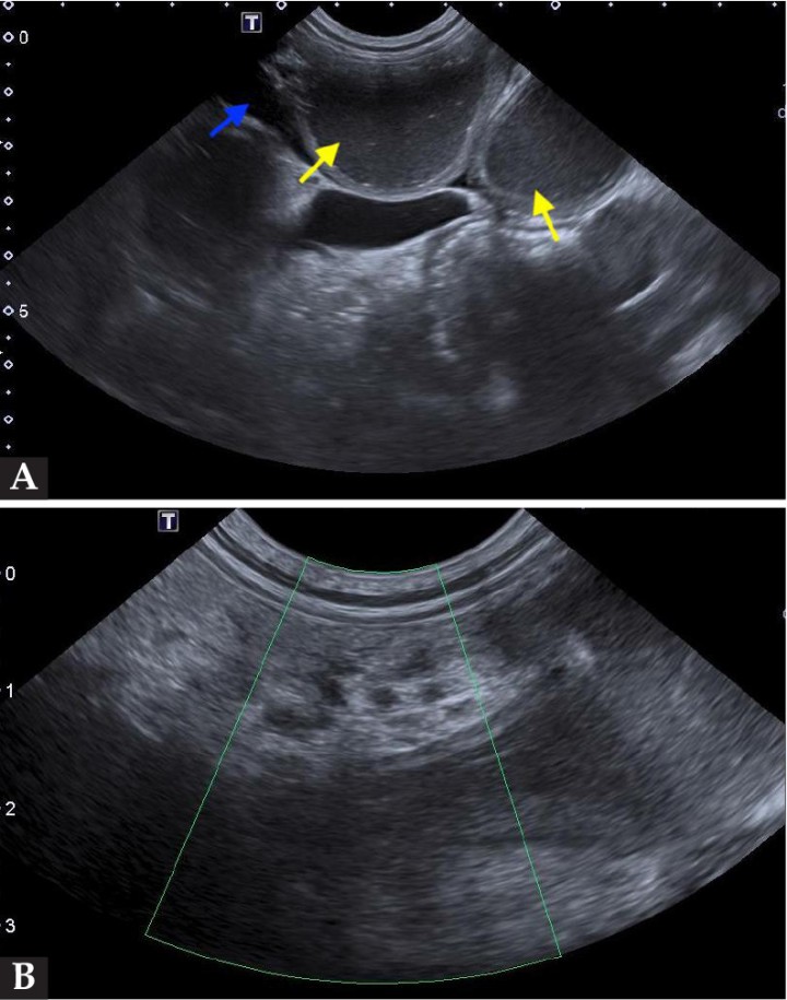 <p>Imágenes ecográficas de la cavidad abdominal. (<strong>A</strong>) Se puede observar las asas intestinales dilatadas con contenido líquido en su interior (flechas amarillas) y líquido libre abdominal (flecha azul). (<strong>B</strong>) Se muestra la ausencia de señal Doppler color en los vasos mesentéricos.</p>