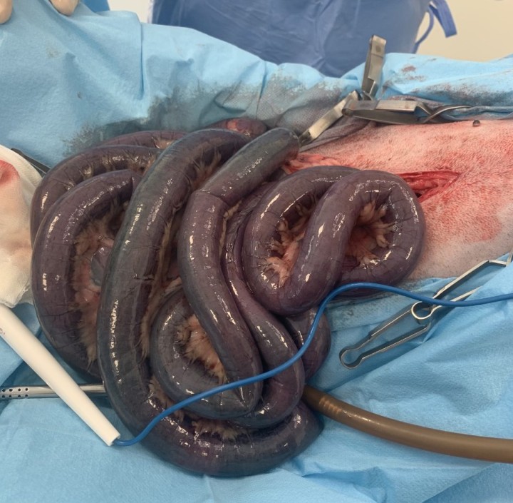 <p>Imagen macroscópica obtenida durante la laparotomía exploratoria realizada al paciente donde se puede observar, de forma generalizada, la necrosis de todo el tracto intestinal.</p>