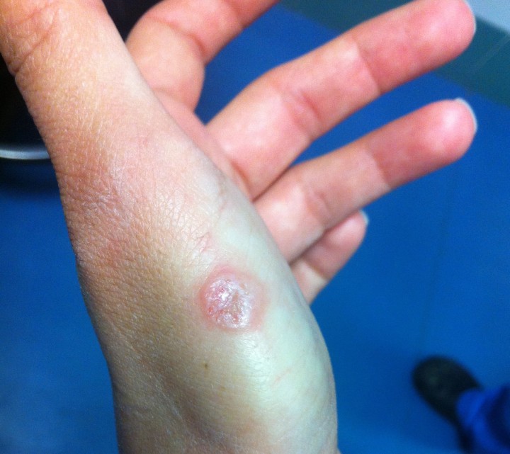 <p><strong>Dermatofitosis humana</strong>. La dermatofitosis (o tiña) constituye la zoonosis más frecuente que encontramos en animales de compañía, siendo la presentación típica humana la mostrada en la imagen, que consiste en lesiones circulares (que pueden ser múltiples) en forma de erupción (parche o placa) eritematosa con los bordes elevados (y en ocasiones descamativos, como el de la imagen) y un centro más claro. Esta morfología suele deberse a la propagación centrífuga del hongo desde el sitio inicial de la infección. Sin embargo, no siempre toman esta morfología, pues como ocurre en gatos, es una enfermedad muy pleomórfica y puede adoptar otras presentaciones.</p>