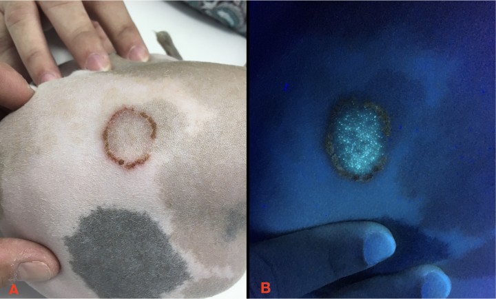 <p><strong>Lámpara de Wood</strong>. Imágenes de un caso curioso de dermatofitosis en un paciente de raza sphinx, una de las conocidas razas “sin pelo”. En realidad conservan el folículo piloso y forman pelos vestigiales que, en muchas ocasiones, no llegan a salir a la superficie, pero que sí son susceptibles de ser infectados por los dermatofitos (en la imagen <strong>A</strong> podemos observar la característica morfología circular de la lesión). Incluso en estos casos, la lámpara de Wood puede ser de ayuda diagnóstica, iluminándose todos los pelos incipientes en los infundíbulos de los folículos pilosos (<strong>B</strong>).</p>