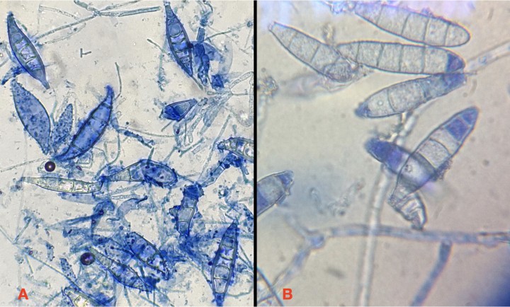 <p><strong>Macroconidias de dermatofitos</strong>. Aunque no existe una técnica “gold standard” para el diagnóstico de dermatofitosis, los cultivos DTM, siguiendo correctamente las instrucciones de cultivo y, posteriormente, realizando una evaluación tanto macroscópica como microscópica, tienen una sensibilidad y especificidad cercana al 97 % (que disminuye mucho si no se realiza la confirmación microscópica, con errores de hasta el 20 %). En la imagen podemos observar macroconidias de <em>Microsporum canis</em> (<strong>A</strong>), ahusadas, con paredes gruesas, ápices puntiagudos y más de 6 septos, así como de <em>Nannizzia gypsea</em> (<strong>B</strong>), ahusadas, con paredes finas, ápices redondeados y menos de 6 septos.</p>