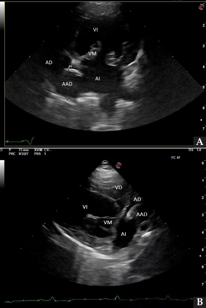 <p>Ecocardiografía. (<strong>A</strong>) Vista apical izquierda de 4 cámaras optimizada para ADD. Engrosamiento de la válvula mitral (VM), dilatación moderada de atrio izquierdo (AI) y ventrículo izquierdo (VI). Estructura redondeada y anecógena de 15 mm con flujo sanguíneo (AAD), adyacente al corazón. AD: atrio derecho. (<strong>B</strong>) Vista paraesternal derecha de 4 cámaras optimizada para el atrio izquierdo. Estructura redondeada y anecógena (AAD) asociada al corazón. AD: atrio derecho.</p>