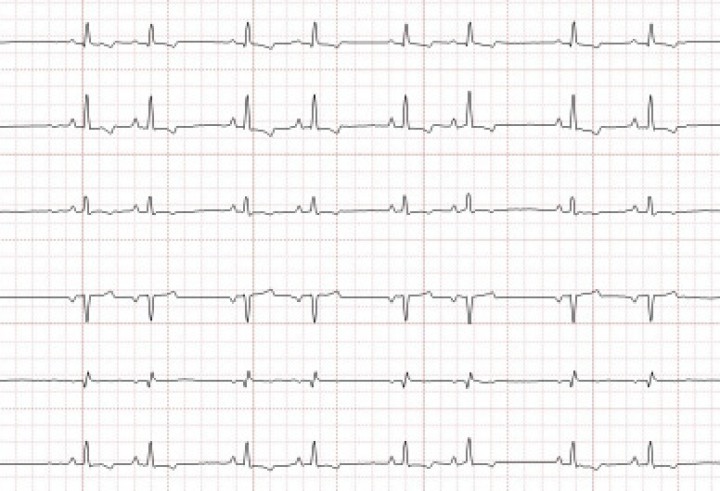 <p>Electrocardiograma de 6 derivadas. Complejos prematuros atriales frecuentes (bigémino). Onda P’ positiva en derivaciones I, II, III y aVF, y negativa en derivaciones aVR y aVL.</p>