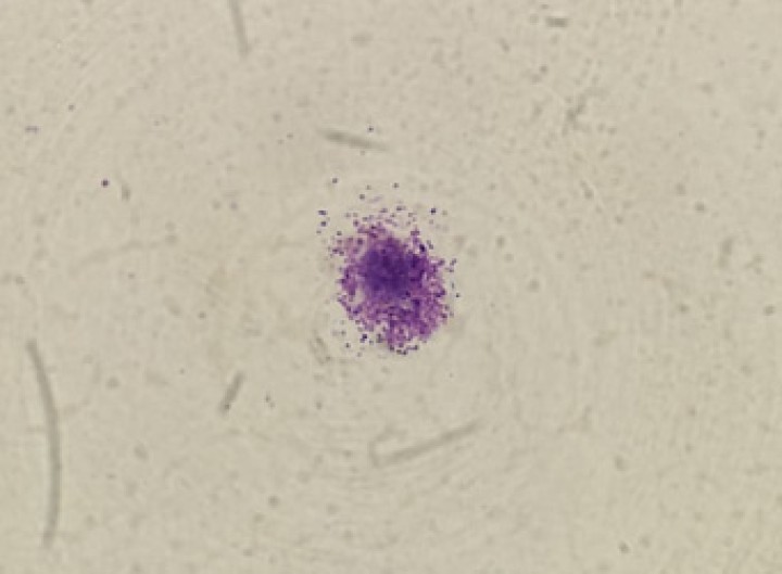 Mastocito en citología de la masa. Obtenido con tinción hematoxilina-eosina en microscopio óptico con lente de objetivo de inmersión en aceite (100x).