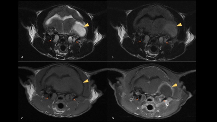 Estudio de resonancia magnética de una paciente felina con otitis media/interna y extensión intracraneal. Planos transversales de resonancia magnética en los que se observa contenido en ambas bullas timpánicas (flechas naranjas) y extensión intracraneal desde el lado izquierdo (cabeza de flecha amarilla). Dicha extensión da lugar a una lesión extraaxial con efecto masa, hiperintensa en T2W (A) y FLAIR (B), isointensa en T1W (C) con captación meníngea en la periferia tras la administración de contraste (T1W+C) (D) compatible con empiema. En este caso se trata de la paciente del vídeo 2C, que se presentó con un estado mental obnubilado, ataxia vestibular severa hacia el lado izquierdo, “head tilt” izquierdo, nistagmo vertical posicional y déficits propioceptivos en las extremidades del lado izquierdo, por lo que se sospechó de una lesión afectando al sistema vestibular central y lateralizada a la izquierda.