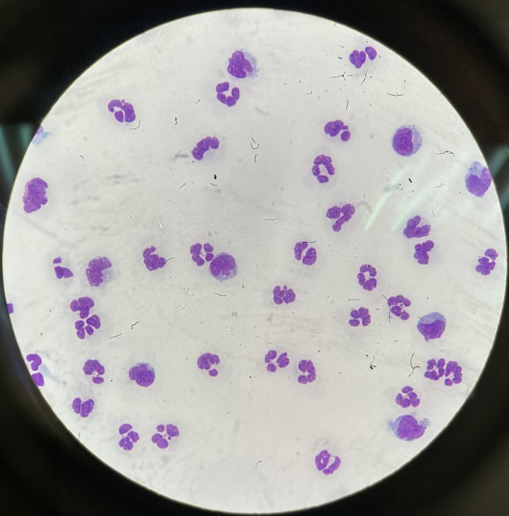 Análisis del LCR: pleocitosis neutrofílica. El LCR en condiciones normales debe ser transparente y sin celularidad (<5 WBC/µl). El contaje celular debe realizarse inmediatamente tras la extracción del LCR y para ello se utiliza la cámara de Neubauer. Si el LCR analizado presenta >5 WBC/µl se denomina pleocitosis. Para determinar el tipo de pleocitosis hay que realizar la citocentrifugación y tinción de la muestra (diff-quick); según la población celular mayoritaria se clasificará como pleocitosis mononuclear, neutrofílica, eosinofílica o mixta. En algunos casos se podrán visualizar agentes infecciosos o células neoplásicas. Según el resultado obtenido y las sospechas en cada caso, se enviará la muestra al laboratorio de referencia para realizar los análisis adicionales que se consideren (medición de microproteínas, PCRs de enfermedades infecciosas, cultivo/antibiograma, PARR, etc.). En la imagen se evidencia la población mayoritaria de neutrófilos en un LCR con una pleocitosis de 536 WBC/µl, por lo que se clasificaría como pleocitosis neutrofílica.