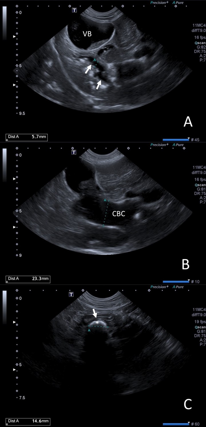 <p>(<strong>A</strong>) Se observa la vesícula biliar (VB) distendida con contenido en su interior, así como dilatación de las vías biliares intrahepáticas (flechas) con pequeñas estructuras hiperecogénicas que causan sombra acústica. (<strong>B</strong>) Conducto biliar común (CBC) marcadamente distendido. (<strong>C</strong>) Conducto biliar común a su llegada a la papila duodenal (flecha), donde se observa una estructura hiperecoica (*) de gran tamaño responsable de la obstrucción.</p>