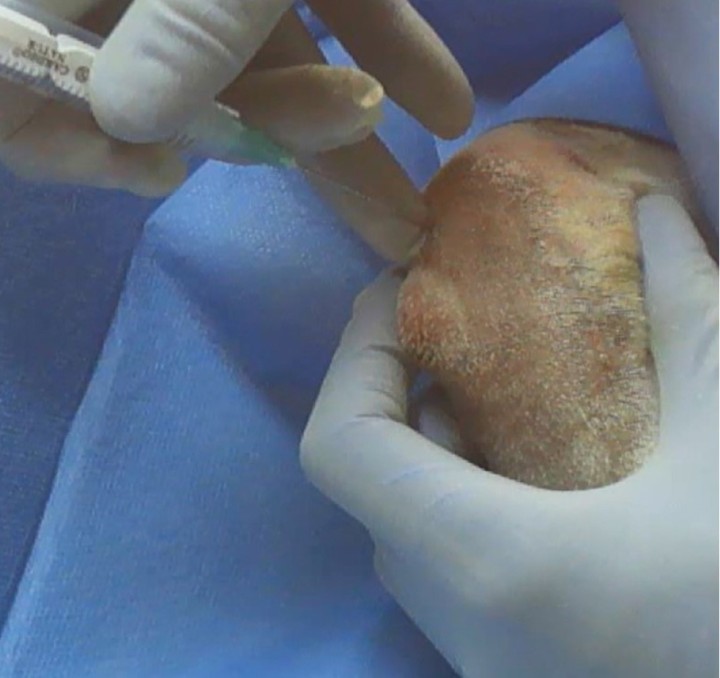 Acceso a la articulación del carpo. Con el animal en decúbito esternal, se flexiona el carpo 90° y la artrocentesis se realiza por la parte dorsal. En la imagen, los dedos están situados hacia la parte inferior de la imagen. Se palpa una depresión, correspondiente al espacio articular antebraquiocarpiano, distal al radio, y en el aspecto craneomedial. La aguja se inserta medial o lateral al tendón extensor común de los dedos y la vena cefálica. Dependiendo del tamaño del animal podremos utilizar agujas de 21-23 G, 1'' y jeringas de 2-5 ml.