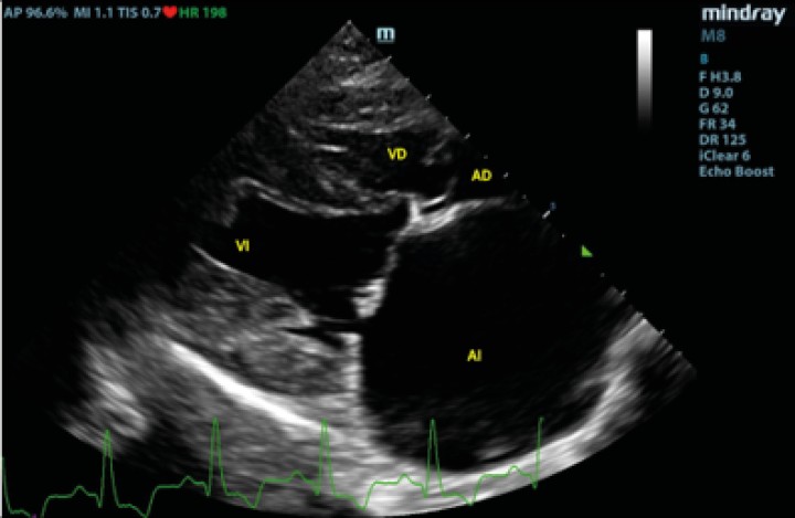<p>Corte paraesternal derecho 4 cámaras, previo a la rotura del atrio izquierdo. VI: ventrículo izquierdo; VD: ventrículo derecho; AI: atrio izquierdo; AD: atrio derecho.</p>