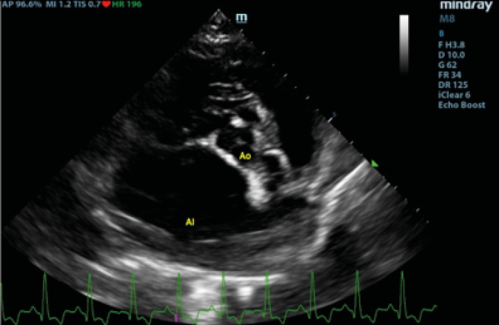 <p>Corte paraesternal derecho transversal a la altura del atrio izquierdo y aorta, previo a la rotura del atrio izquierdo. Ao: aorta; AI: atrio izquierdo.</p>