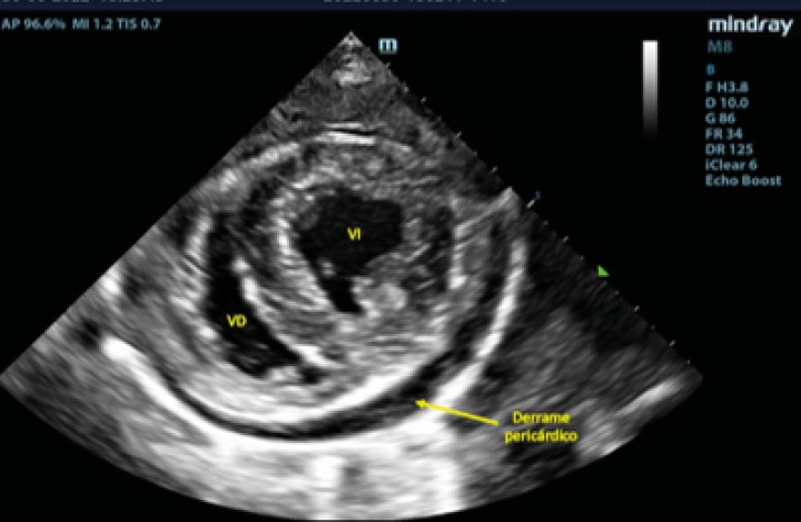 <p>Examen TFAST tras la rotura del atrio izquierdo donde podemos observar un corte transversal del corazón a la altura de los músculos papilares de ventrículo izquierdo. Se puede observar la presencia de derrame pericárdico. VD: ventrículo derecho; VI: ventrículo izquierdo.</p>