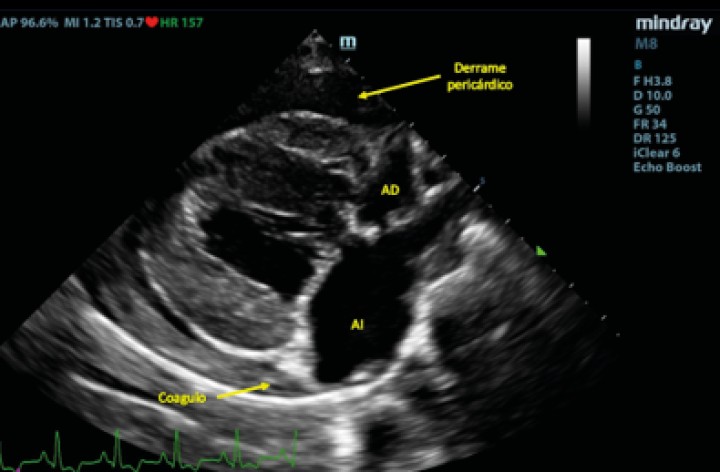 <p>Corte paraesternal derecho 4 cámaras tras la rotura del atrio izquierdo. Se puede observar la formación de una estructura compatible con un coágulo dentro del saco pericárdico. AD: atrio derecho; AI: atrio izquierdo.</p>