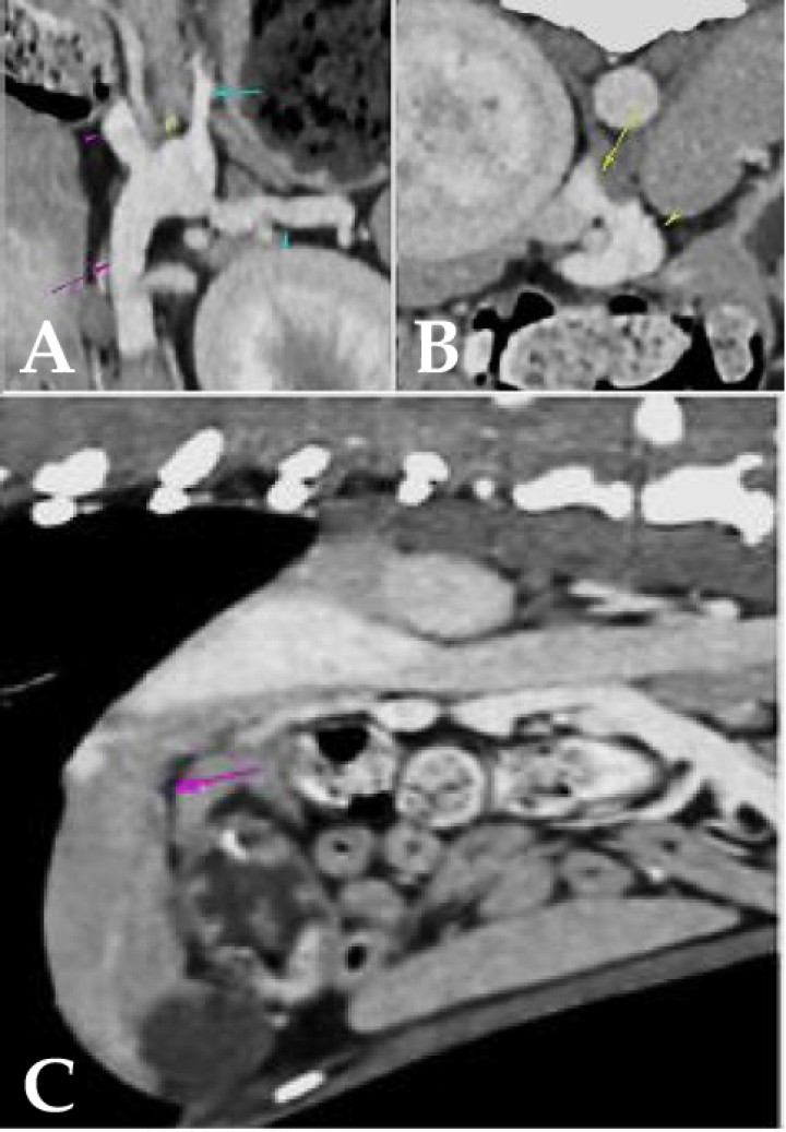 <p>Visualización de shunt portosistémico (SPS). (<strong>A</strong>) La vena porta (flecha rosa) presenta diámetro decreciente en sentido caudocraneal, midiendo 0,67 cm caudalmente a la recepción de la vena esplénica y 0,4 cm en el porta hepatis (punta de flecha rosa: vena porta cranealmente a la recepción de la vena esplénica). (<strong>A</strong>, <strong>B</strong>) La vena gástrica izquierda (flecha azul) deriva parcialmente en la vena esplénica (punta de flecha azul) y en un vaso anómalo que parte desde la vena esplénica, en la región comprendida entre la vena gástrica izquierda y la vena porta (punta de flecha amarilla), y se dirige craneodorsalmente a la vena cava caudal (flecha amarilla), en la que deriva por el lado izquierdo, cranealmente a la arteria celíaca. Este vaso anómalo mide aproximadamente 0,67 cm de diámetro) diagnosticado mediante TC con contraste. (<strong>C</strong>) Microhepatía (flecha morada) asociada a SPS mediante TC.</p>