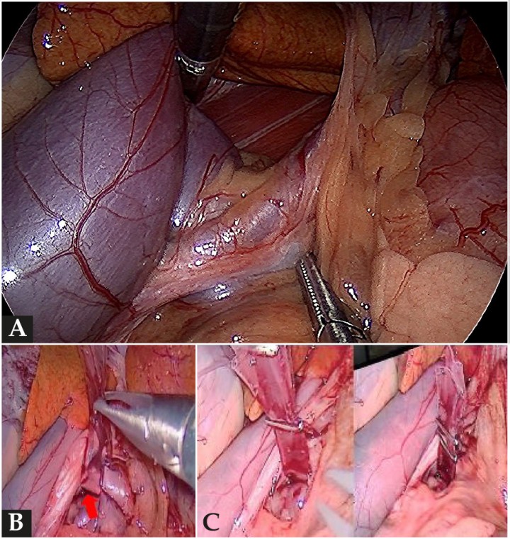 <p>(<strong>A</strong>) Identificación y disección de SPS mediante laparoscopia. (<strong>B</strong>) Aislamiento de SPS mediante banda de celofán (flecha roja). (<strong>C</strong>) Cierre atenuado de SPS esplenocava mediante una banda de celofán con grapadora por laparoscopia.</p>