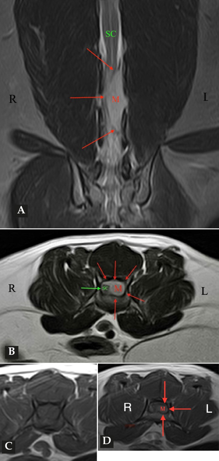 <p>Imágenes de RM postcontraste en las que se identifica una lesión de forma alargada y ancha en su base, con distribución posiblemente extradural y/o intradural/extramedular a nivel de la vértebra L6 (flechas rojas). (<strong>A</strong>) Secuencia dorsal en STIR. (<strong>B</strong>) Secuencia transversal en T2. Nótese la compresión severa a la que es sometida la médula espinal (flecha verde). (<strong>C</strong>) Secuencia transversal en T1 precontraste. (<strong>D</strong>) Secuencia transversal en T1 postcontraste. M: masa; SC: médula espinal; R: derecha; L: izquierda.</p>