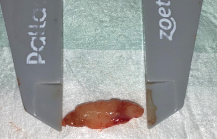 <p>Aspecto macroscópico de la lesión.</p>