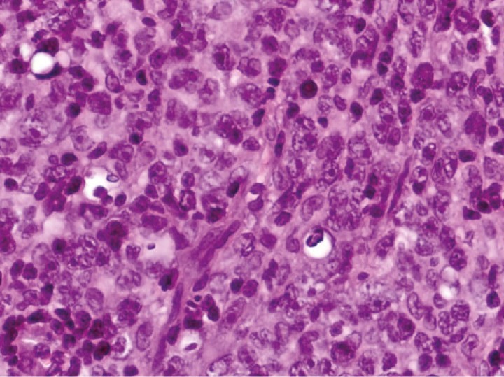 <p>Imagen del estudio histopatológico donde se observa proliferación de células redondas de medio tamaño con patrón difuso (H&E, 400x).</p>