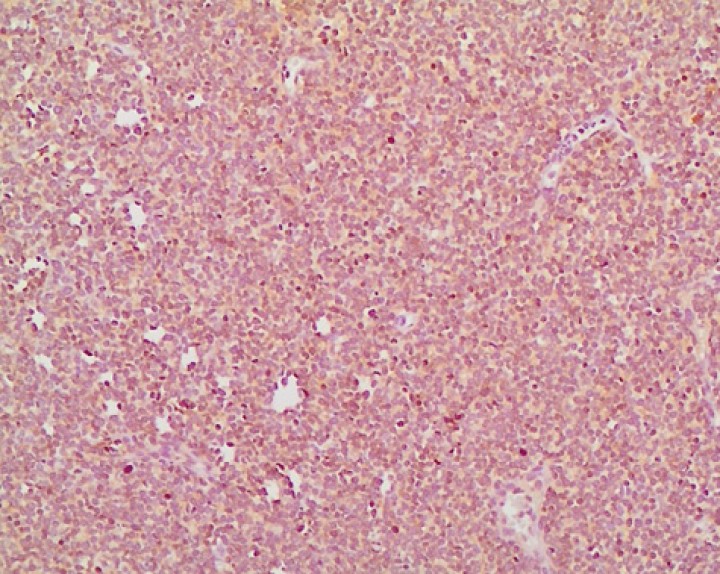 <p>Inmunotipificación del tumor, positivo en más del 95 % de las células linfoides neoplásicas (CD20, 200x).</p>