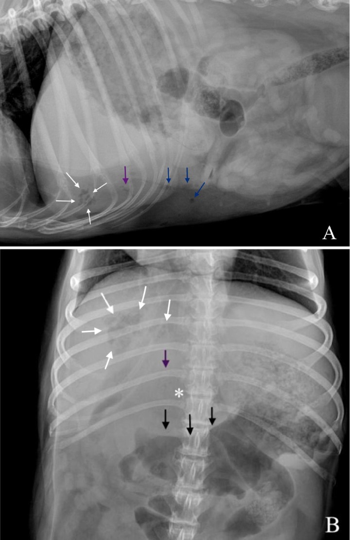 <p>Imágenes ampliadas de las radiografías en proyección lateral izquierda (<strong>A</strong>) y ventrodorsal (<strong>B</strong>). Se observa la lesión de opacidad gas y bordes irregulares localizada en la proyección hepática, en su aspecto craneoventral y lateralizada a la derecha (flechas blancas). Se muestra otra lesión de opacidad gas, de menor tamaño respecto a la descrita, en la zona media del hígado (flechas moradas), que provoca un efecto masa (*) y genera un desplazamiento hacia caudal del antro pilórico y cuerpo gástrico (flechas negras). Caudoventral a la silueta hepática se observan pequeñas burbujas de gas libre compatible con neumoperitoneo (flechas azules).</p>