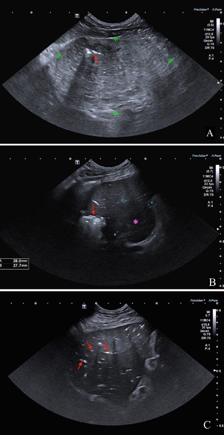 <p>Imágenes ecográficas del parénquima hepático mostrando diferentes lesiones. (<strong>A</strong>) Se observa una masa hepática (*) con presencia de gas intralesional (flecha roja). (<strong>B</strong>) Lesión hepática con gas en su interior que produce artefacto de reverberación (flecha roja) y un nódulo hipoecoico y bien delimitado (*). (<strong>C</strong>) Se aprecian múltiples acúmulos de gas intraparenquimatosos a nivel intravascular (flechas rojas).</p>