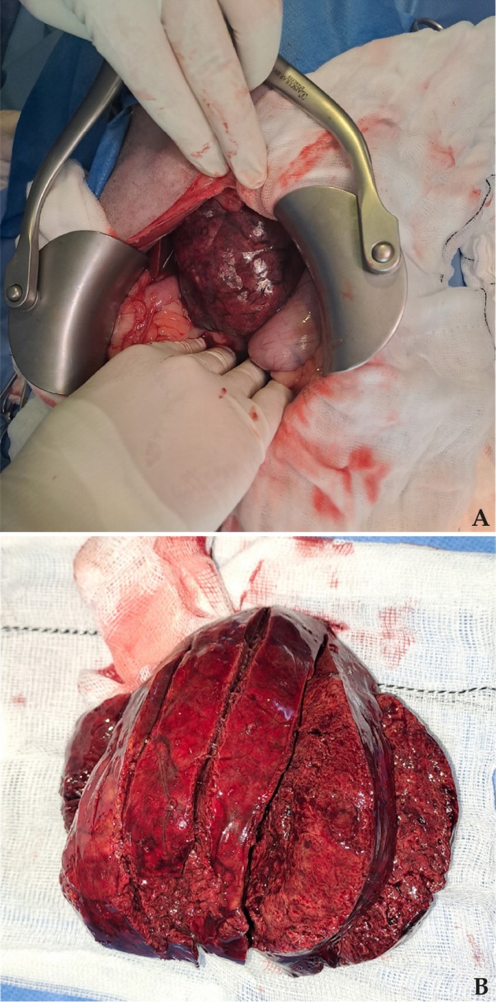 <p>Imágenes realizadas en la intervención en las que se observa la masa de mayor tamaño compatible con un carcinoma hepatocelular bien diferenciado (cedidas por Gustavo Ortiz, Hospital Clínico Veterinario Complutense, Universidad Complutense de Madrid. Avenida Puerta de Hierro s/n, 28040 Madrid).</p>