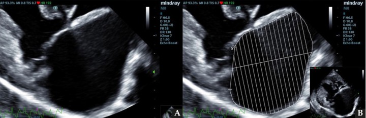 ECDM. (A) Medida mediante MOD del volumen del AI. (B) Corte paraesternal derecho 4 cámaras, zoom AI. Ratio LA/BW = 3, 8 ml/kg.