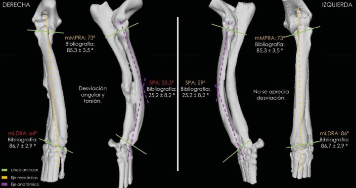 Comparativa en 3D de ambas extremidades con la correspondiente deformidad.